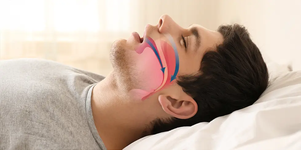 Why mouth breathing is detrimental to your health